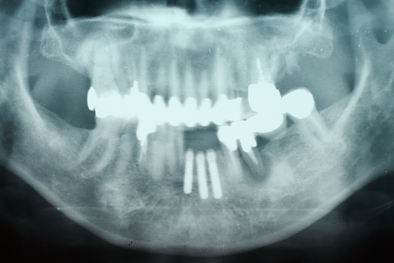前歯インプラント　骨再生治療　パノラマレントゲン